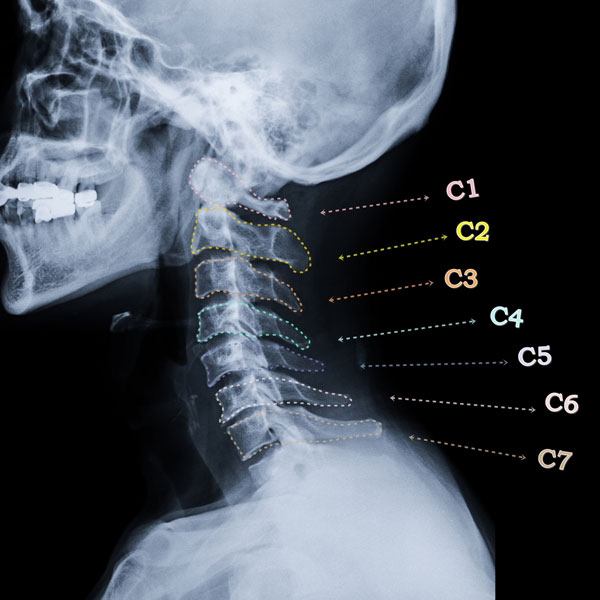 Anterior and Vertical Translations of the Cervical Spine Increase Stresses up to 4.25 Times; Likely Accelerating the Development of Spinal Arthritis and Disc Disease