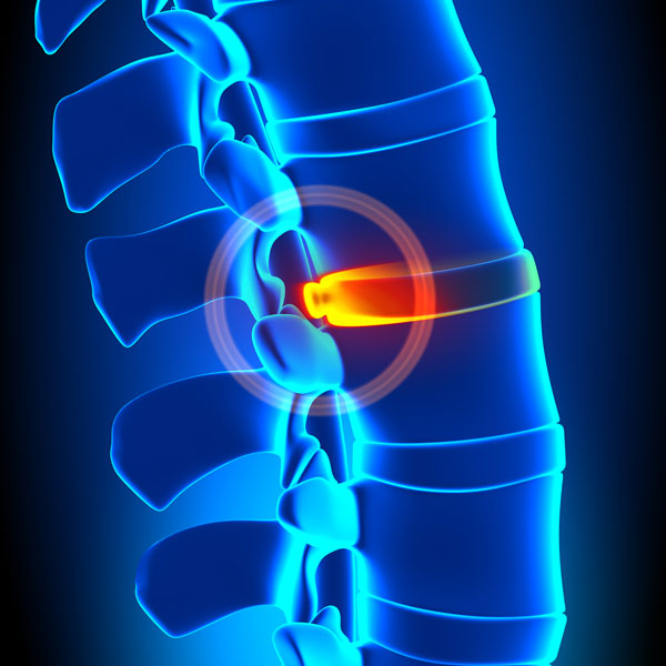 Abnormal Cervical Spine Curvatures May Increase Loads on Your Spine by 6-10 Times; Accelerating the Development of Spinal Arthritis and Disc Disease