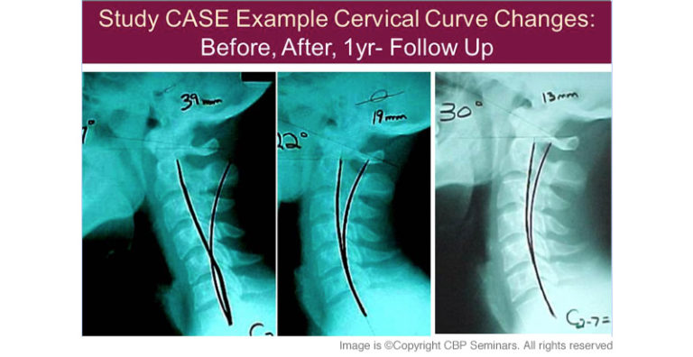 Improving Your Neck Configuration With Chiropractic BioPhysics ...