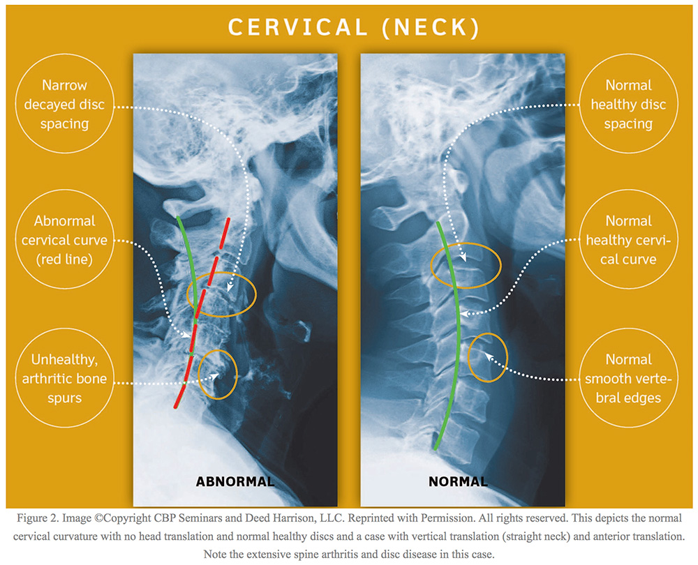 Heading перевод. Types of cervical Disc diseases.