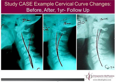 Improvement In Neck Curve and Posture Using the Denneroll Improves Neck ...