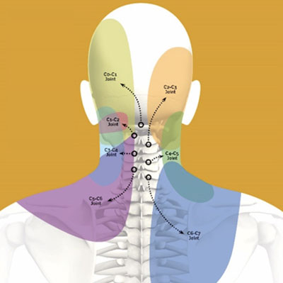 Abnormal Neck Curvatures Are 18 Times More Common in Chronic Neck Pain Subjects Compared to Non Pain Persons