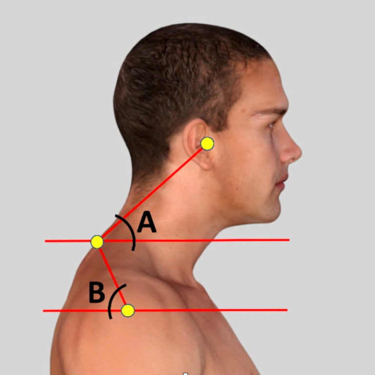 Forward Head Posture Found to be a Primary Cause of Altered Sensori ...