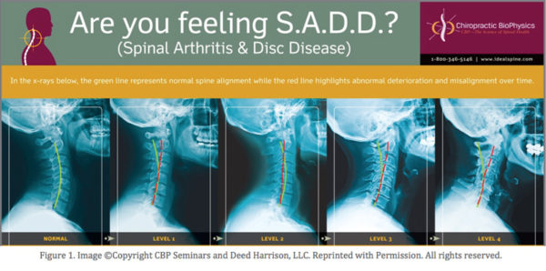 Abnormal Cervical Spine Curvatures May Increase Loads On Your Spine By ...