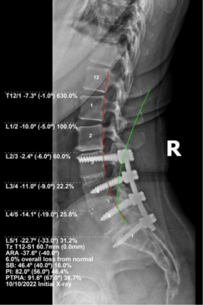 lateral lumbar radiograph with PostureRay Biomechanical assessment